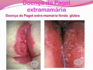 Doença de Paget
extramamária
Doença de Paget extra-mamária fenda glútea
 