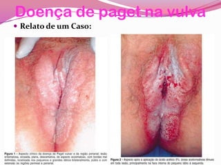 Doença de paget na vulva
 Relato de um Caso:
 