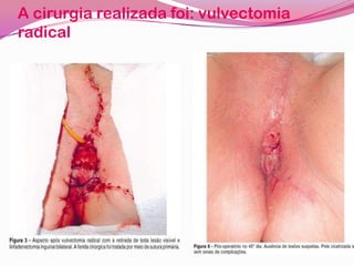 A cirurgia realizada foi: vulvectomia
radical
 