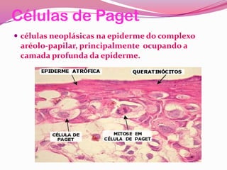 Células de Paget
 células neoplásicas na epiderme do complexo
aréolo-papilar, principalmente ocupando a
camada profunda da epiderme.
 