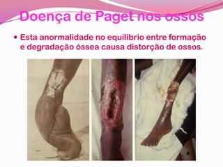 Doença de Paget nos ossos
 Esta anormalidade no equilíbrio entre formação
e degradação óssea causa distorção de ossos.
 