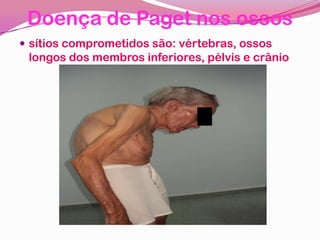 Doença de Paget nos ossos
 sítios comprometidos são: vértebras, ossos
longos dos membros inferiores, pélvis e crânio
 