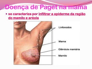 Doença de Paget na mama
 se caracteriza por infiltrar a epiderme da região
do mamilo e aréola
 