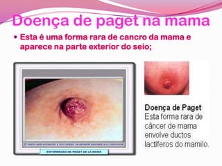Doença de paget na mama
 Esta é uma forma rara de cancro da mama e
aparece na parte exterior do seio;
 