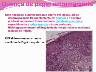 Doença de paget extramamária
Uma neoplasia cutânea rara que ocorre em idosos. Ele se
desenvolve mais freqüentemente em mulheres e envolve
predominantemente áreas contendo glândulas apócrinas,
especialmente a vulva, escroto e áreas perianais.
Histologicamente por infiltração da derme por células malignas
(células de Paget).
DPEM do escroto mostrando
as células de Paget na epiderme
 