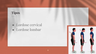 Tipos
● Lordose cervical
● Lordose lombar
8
 