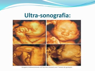 Ultra-sonografia:
 