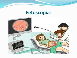 Fetoscopia:
 