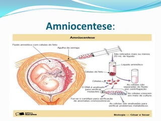 Amniocentese:
 
