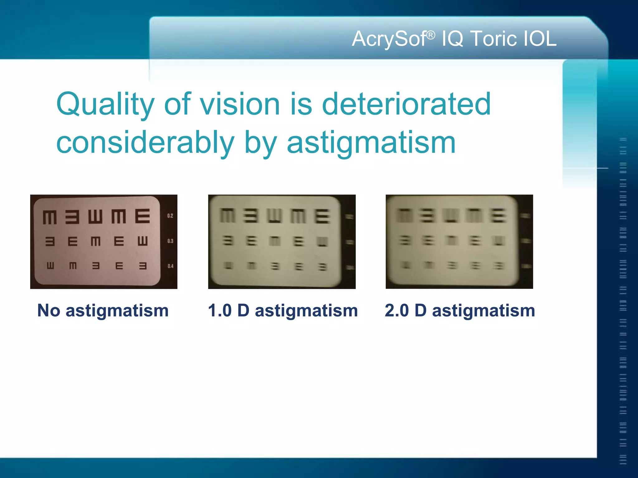No astigmatism 1.0 D astigmatism 2.0 D astigmatism Quality of vision is deteriorated  considerably by astigmatism 