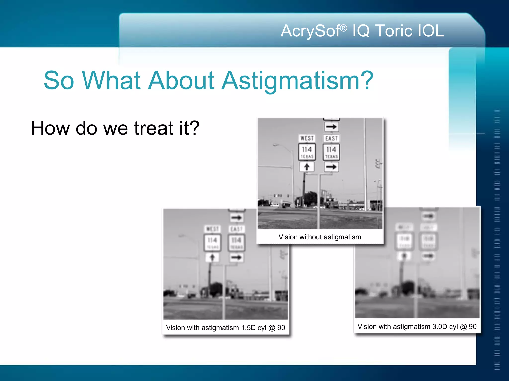 How do we treat it? So What About Astigmatism? Vision without astigmatism Vision with astigmatism 1.5D cyl @ 90 Vision with astigmatism 3.0D cyl @ 90 