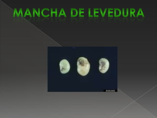 Esta doença ocorre em todas as regiões produtoras de feijão e se manifesta principalmente nas folhas do feijoeiro, sendo as hastes e as vagens pouco atingidas.