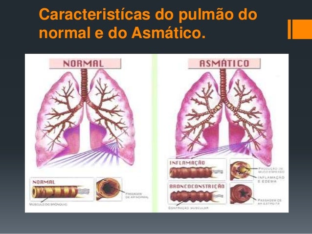 Asma,bronquite,rinite e sinusite.Seus aspecto fisiológico