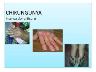 CHIKUNGUNYA
Intensa dor articular
 