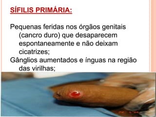 SÍFILIS PRIMÁRIA:
Pequenas feridas nos órgãos genitais
(cancro duro) que desaparecem
espontaneamente e não deixam
cicatrizes;
Gânglios aumentados e ínguas na região
das virilhas;
 