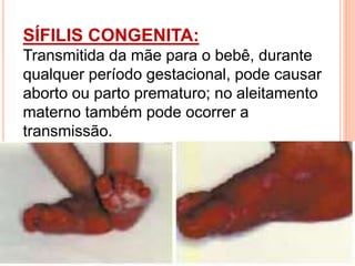 SÍFILIS CONGENITA:
Transmitida da mãe para o bebê, durante
qualquer período gestacional, pode causar
aborto ou parto prematuro; no aleitamento
materno também pode ocorrer a
transmissão.
 