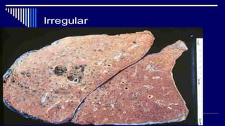 ENFISEMA PANACINAR
_____________________________________________
 