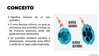 ➢ Significa excesso de ar nos
pulmões;
➢ É uma doença crônica, na qual as
estruturas dos pulmões incham-se
de maneira excessiva onde são
gradualmente destruídos.
➢ Os pulmões também perdem a
elasticidade, tornando mais difícil
a saída do ar após cada inspiração.
CONCEITO
Fonte: Google Imagens
 