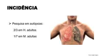 ➢ Pesquisa em autópsias:
2/3 em H. adultos
1/7 em M. adultas
INCIDÊNCIA
Fonte: Google Imagens
 