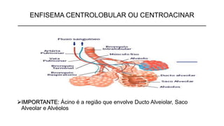 ENFISEMA CENTROLOBULAR OU CENTROACINAR
__________________________________________________
➢IMPORTANTE: Ácino é a região que envolve Ducto Alveiolar, Saco
Alveolar e Alvéolos
 