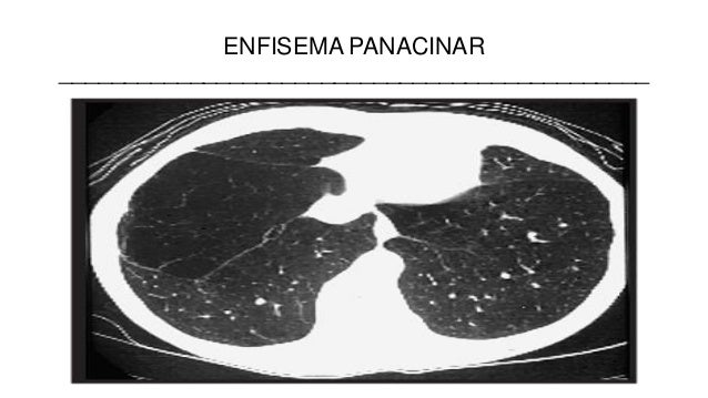 Enfisema Pulmonar Enfisema Pulmonar