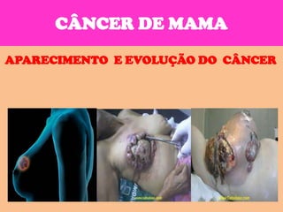 CÂNCER DE MAMA

APARECIMENTO E EVOLUÇÃO DO CÂNCER
 