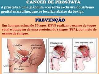 CÂNCER DE PRÓSTATA
A próstata é uma glândula acessória exclusiva do sistema
genital masculino, que se localiza abaixo da bexiga.

                    PREVENÇÃO
Em homens acima de 50 anos, DEVE realizar o exame de toque
retal e dosagem de uma proteína do sangue (PSA), por meio de
exame de sangue.
 