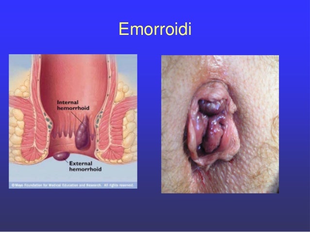 Emorroidi medicina sanguinante