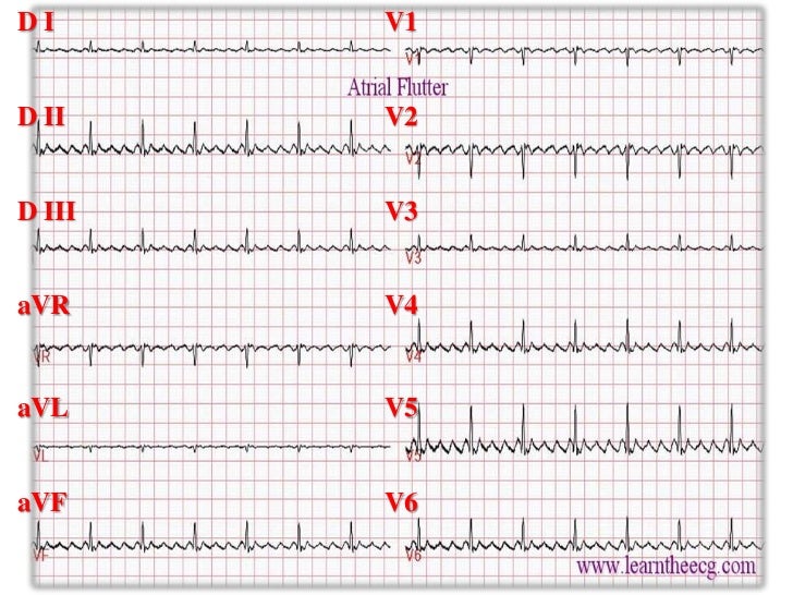 Flutter Atrial