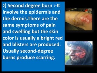 2) Second degree burn :-It
involve the epidermis and
the dermis.There are the
same symptoms of pain
and swelling but the skin
color is usually a bright red
and blisters are produced.
Usually second-degree
burns produce scarring.
 