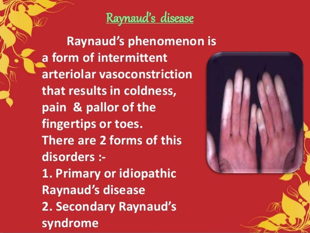 Slide for raynaud's disease