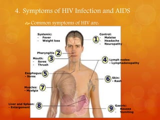 4. Symptoms of HIV Infection and AIDS 
Common symptoms of HIV are: 
Systemic: 
- Fever 
- Weight loss 
Control: 
- Malaise 
- Headache 
- Neuropathy 
Pharyngitis 
Mouth: 
- Sores 
- Thrush 
Lymph nodes: 
- Lymphadenopathy 
Esophagus: 
- Sores 
Skin: 
- Rash 
Muscles: 
- Myalgia 
Liver and Spleen: 
- Enlargement 
Gastric: 
- Nausea 
- Vomiting 
 