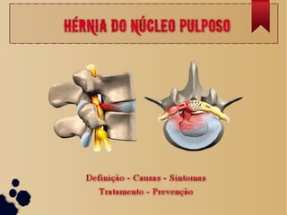 Ortopedia - Hérnia do Núcleo Pulposo (Hérnia de disco)