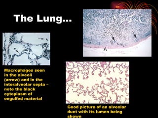 The Lung… Macrophages seen in the alveoli (arrow) and in the interalveolar septa – note the black cytoplasm of engulfed material Good picture of an alveolar duct with its lumen being shown 