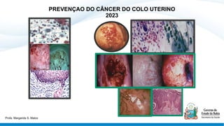 PREVENÇAO DO CÂNCER DO COLO UTERINO
2023
Profa. Margarida S. Matos
 