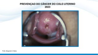PREVENÇAO DO CÂNCER DO COLO UTERINO
2023
Profa. Margarida S. Matos
 