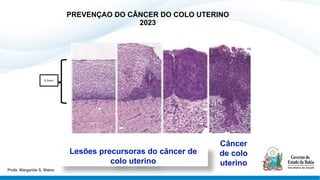 PREVENÇAO DO CÂNCER DO COLO UTERINO
2023
0,5mm
Lesões precursoras do câncer de
colo uterino
Câncer
de colo
uterino
Profa. Margarida S. Matos
 