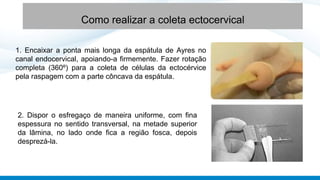 Como realizar a coleta ectocervical
1. Encaixar a ponta mais longa da espátula de Ayres no
canal endocervical, apoiando-a firmemente. Fazer rotação
completa (360º) para a coleta de células da ectocérvice
pela raspagem com a parte côncava da espátula.
2. Dispor o esfregaço de maneira uniforme, com fina
espessura no sentido transversal, na metade superior
da lâmina, no lado onde fica a região fosca, depois
desprezá-la.
 