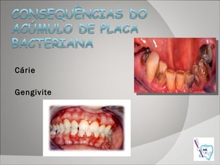 Cárie Gengivite 