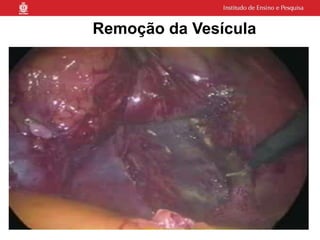 Remoção da Vesícula
 