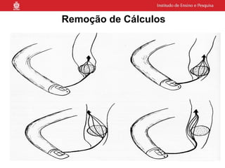 Remoção de Cálculos
 