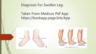 Diagnosis For Swollen Leg:
Taken From Medicos Pdf App:
https://bookapp.page.link/App
 