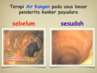 sebelum sesudah
Terapi Air Kangen pada usus besar
penderita kanker payudara
 