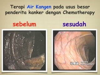 sebelum sesudah
Terapi Air Kangen pada usus besar
penderita kanker dengan Chemotherapy
 