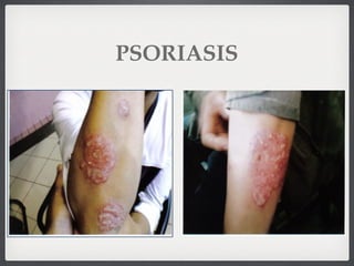 PSORIASIS
 
