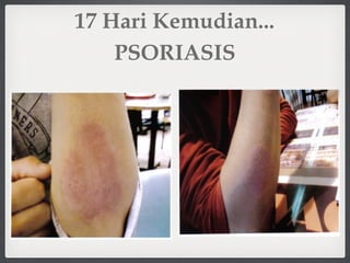 PSORIASIS
17 Hari Kemudian...
 