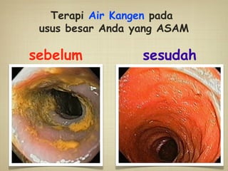 sebelum sesudah
Terapi Air Kangen pada
usus besar Anda yang ASAM
 