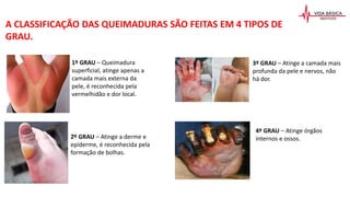 A CLASSIFICAÇÃO DAS QUEIMADURAS SÃO FEITAS EM 4 TIPOS DE
GRAU.
1º GRAU – Queimadura
superficial, atinge apenas a
camada mais externa da
pele, é reconhecida pela
vermelhidão e dor local.
2º GRAU – Atinge a derme e
epiderme, é reconhecida pela
formação de bolhas.
3º GRAU – Atinge a camada mais
profunda da pele e nervos, não
há dor.
4º GRAU – Atinge órgãos
internos e ossos.
 