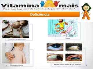Desnutrição energético-proteico
Infecções respiratórias
Diarreia
Cegueira noturna, mancha de bitot, xeroftalmia
Deficiência
 
