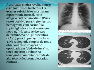  A avaliação clínica revelou roncos
e sibilos difusos bilaterais. Os
exames subsidiários mostraram:
espirometria normal, teste
alérgico cutâneo imediato (Prick
teste) positivo para A. fumigatus,
hemograma com eosinofilia
(13%), IgE sérica total maior que
1.000 ng/ml, teste sérico para
determinação de IgE específica
(RAST) para A. fumigatus classe
3. Na radiografia simples de tórax
observaram-se imagens de
opacidade em "dedo de luva" no
terço superior direito e na
tomografia computadorizada de
alta resolução, bronquiectasias
centrais .
 